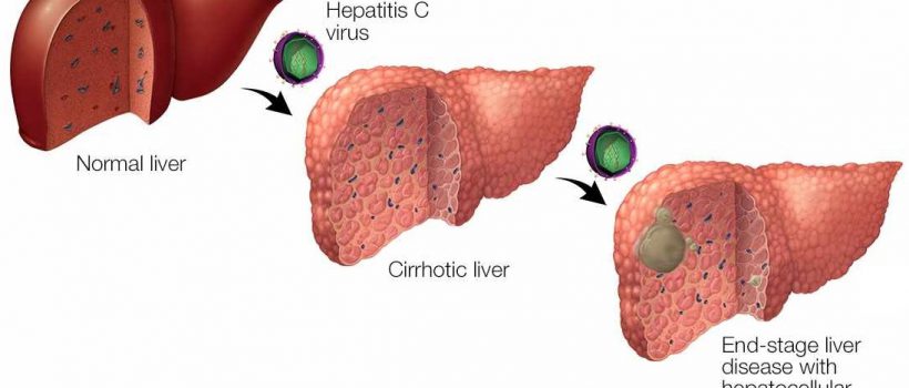 Long Term Effects Of Having Hepatitis